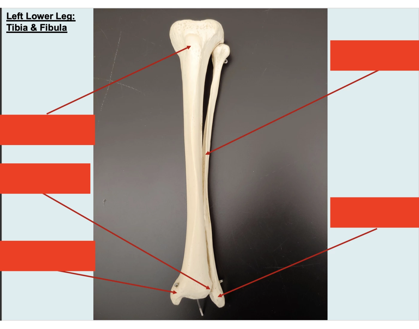 Left Lower Leg: Tibia & Fibula Quiz