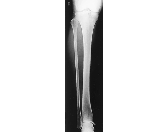 AP TIBIA AND FIBULA Quiz
