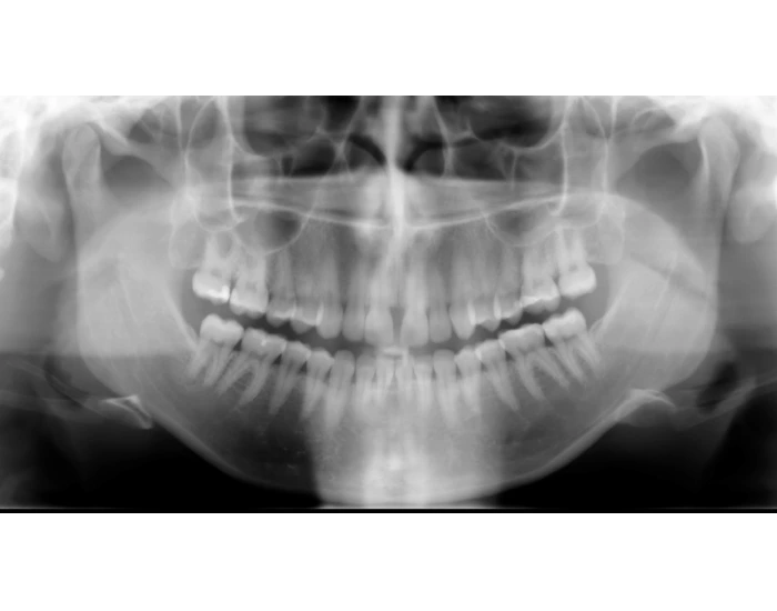 Panoramic radiographic anatomy — Printable Worksheet