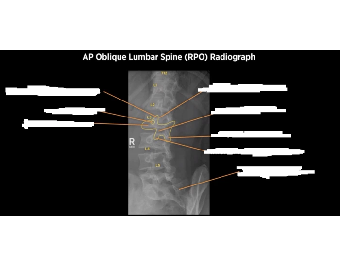 AP Oblique Lumbar Spine (RPO) X-ray Anatomy Quiz