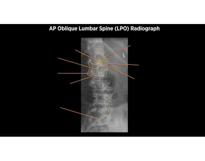 Lpo Radiography AP Oblique Lumbar Spine (LPO) X-ray Anatomy — Printable Worksheet