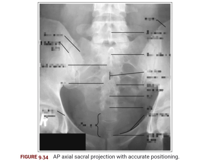 Axial Projection Example Radiology AP axial sacral projection Quiz