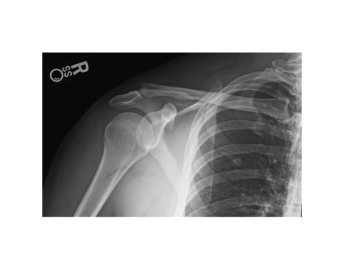 AP Shoulder Neutral X-Ray (Neutral Rotation) Quiz