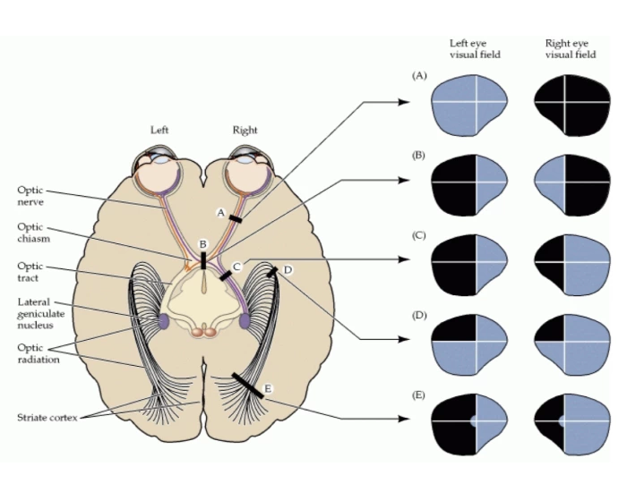 Visual Function Damage Damage to Visual pathways Quiz