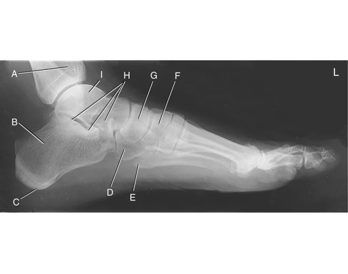 Left Lateral Foot X Ray Quiz Left lateral foot x ray quiz