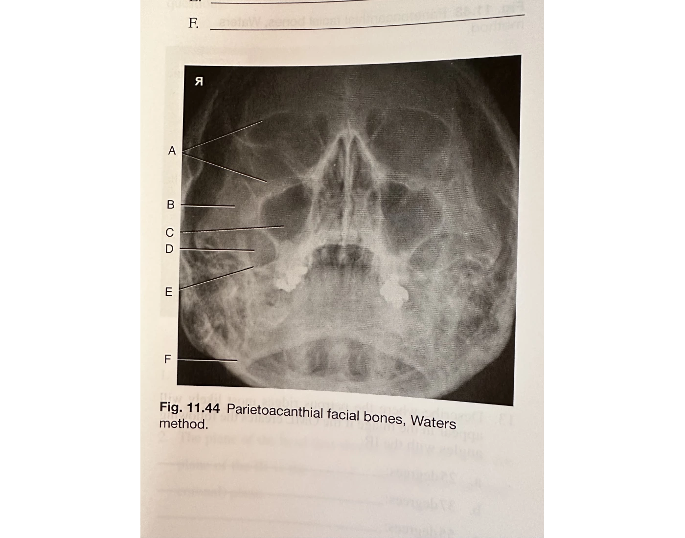 Waters Method Radiograph Waters method for Facial bones Quiz