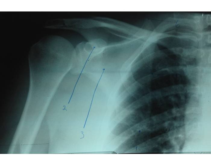 Shoulder Anatomy 3 Quiz