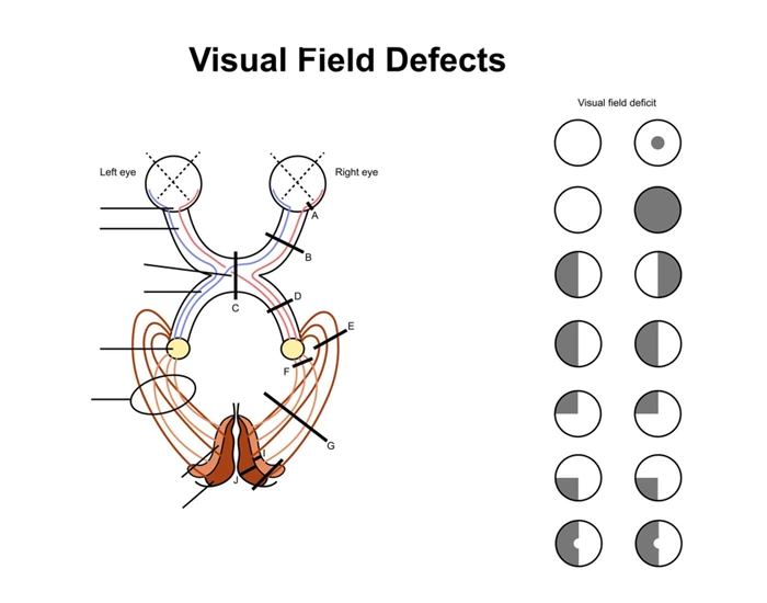 Visual Fields — Printable Worksheet