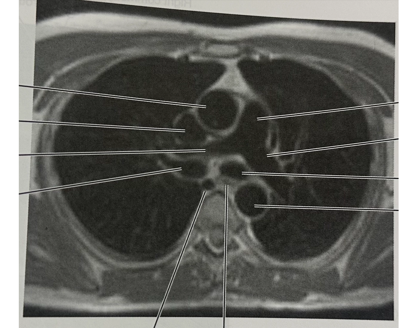 Chest Mri Sample Fig. 6.77 Axial MRI of chest w/ pulmonary trunk Quiz