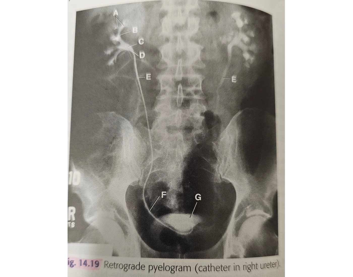 Retrograde pyelogram Quiz