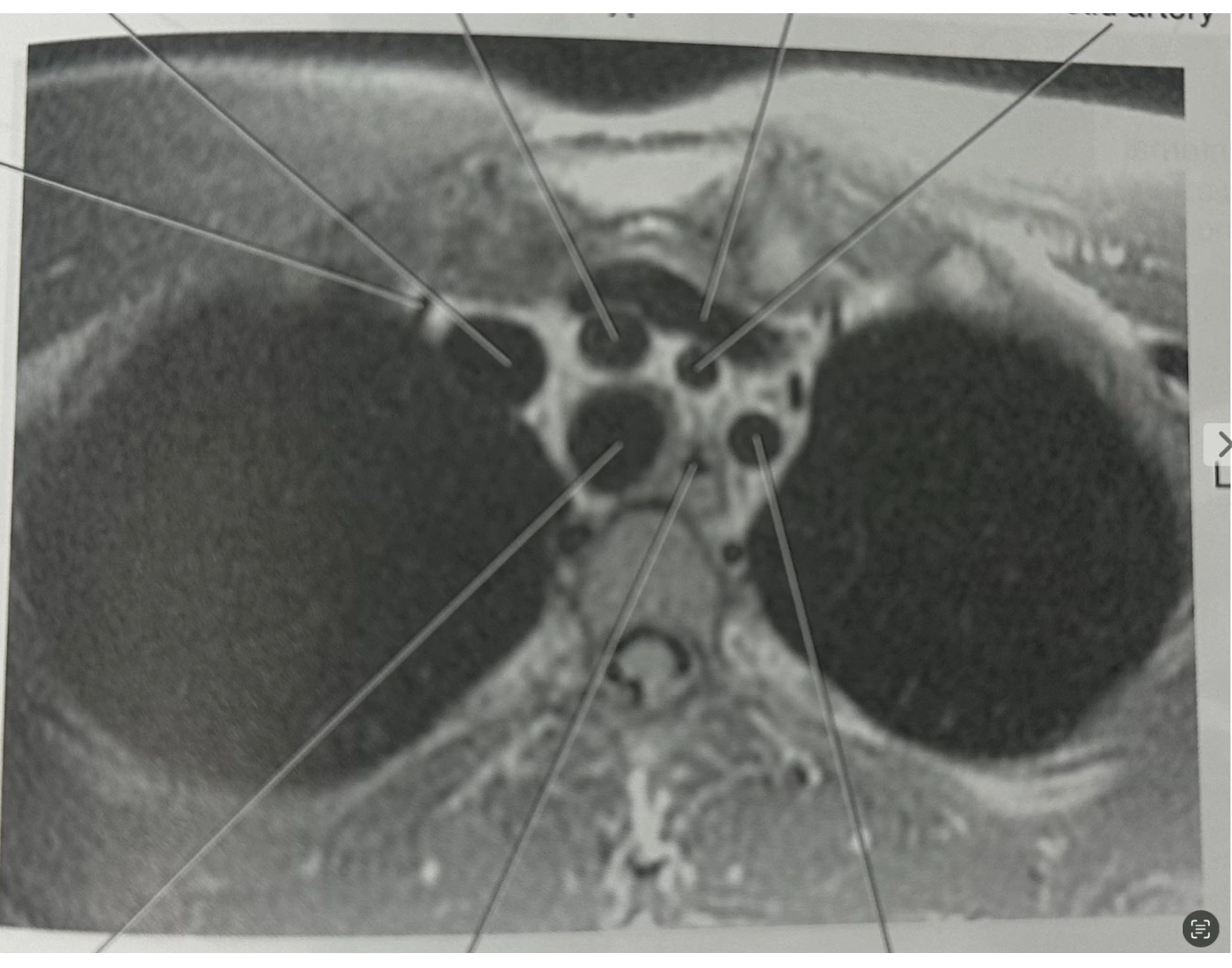 Chest Mri Sample Fig. 6.98 Axial MRI of chest Quiz
