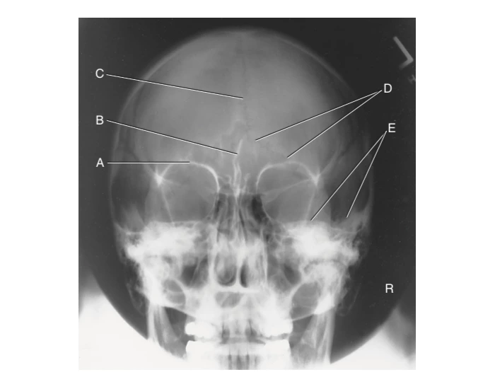 Skull Anatomy: PA Caldwell Quiz