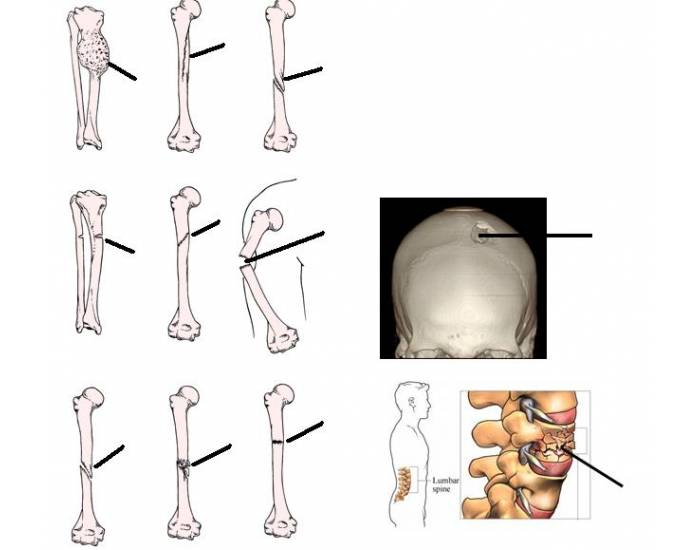 create-a-fracture: broken bones and fracture types... Unit 3 Part 2: Types of Bone Fractures Quiz