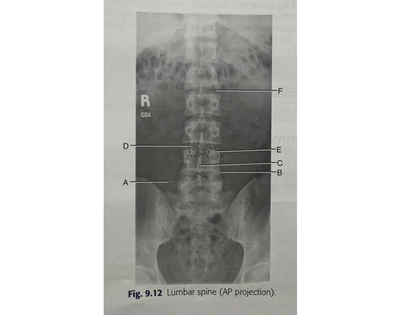 Spinal Projection Lumbar spine (AP projection) Quiz
