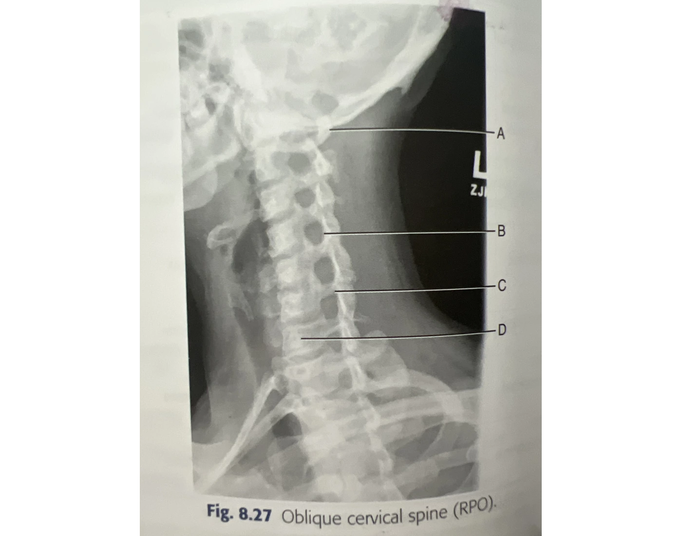 Xr Rpo View Oblique cervical spine (RPO) Quiz