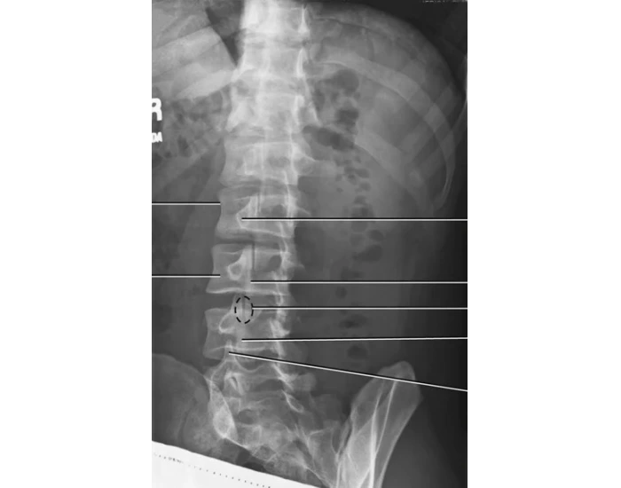 Xr Rpo View Lumbar RPO X-Ray Quiz