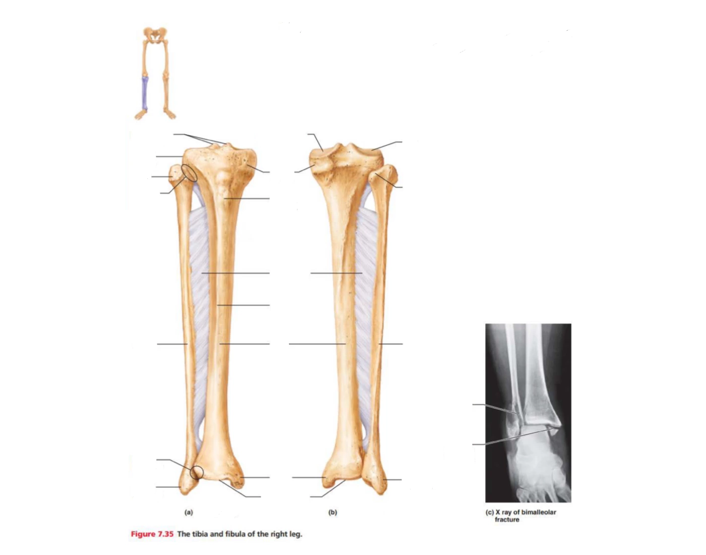 Tibia and fibula (right leg) — Printable Worksheet