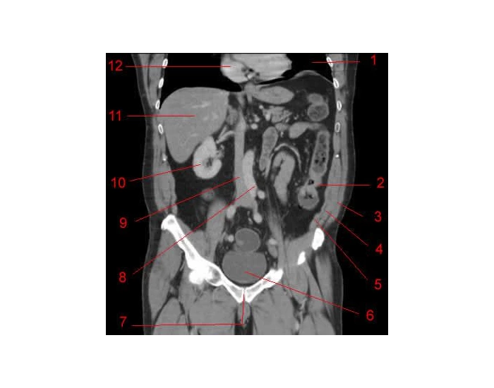 Digestive Ct Scan Coronal CT digestive system Quiz