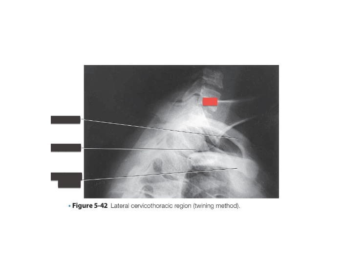 Twining Method Radiography Lateral cervicothoracic region (twining method). Quiz