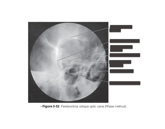 Reverse Rhese Method Parietoorbital oblique optic canal (Rhese method). Quiz