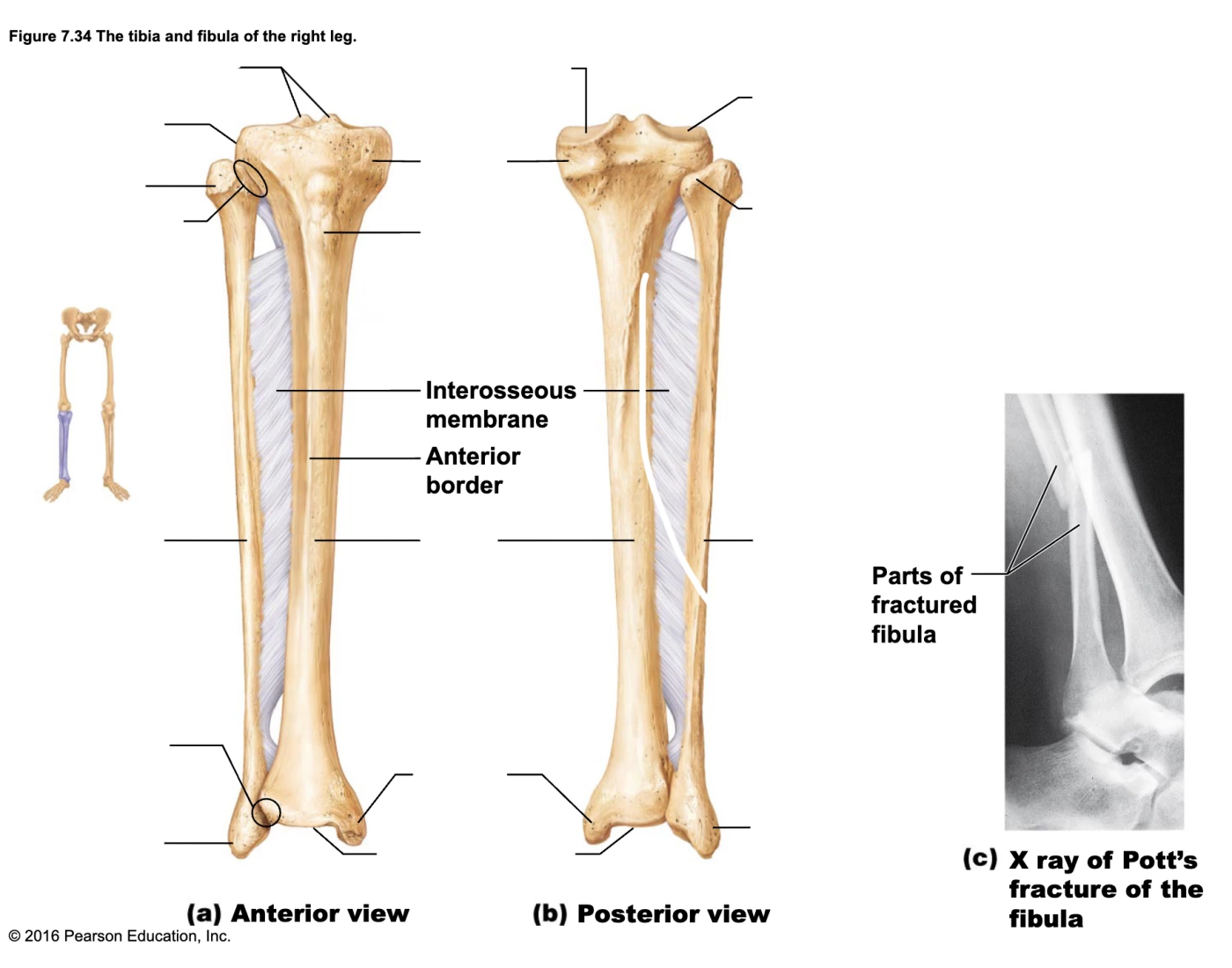 Tibia and fibula of right leg, Amelia Massa — Printable Worksheet