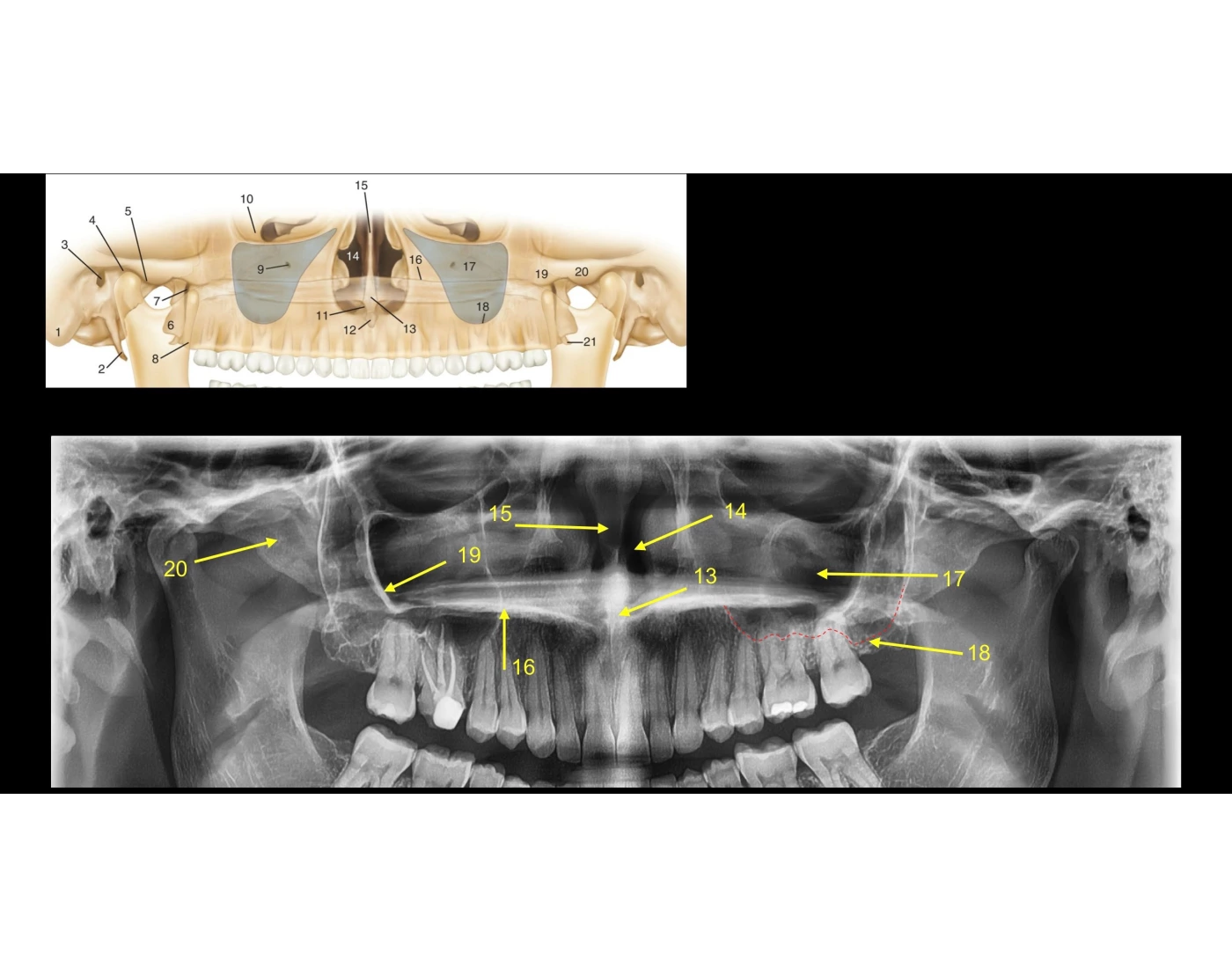 Max. & Mand. Panoramic Radiograph structures pt 2 Quiz