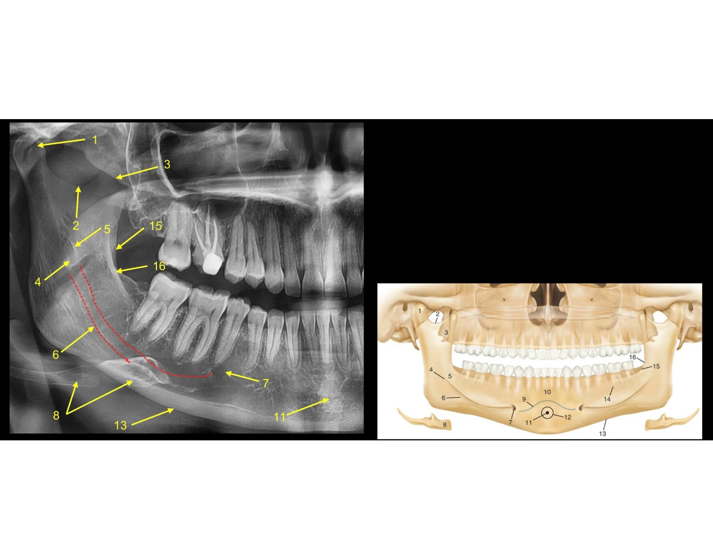 Max. & Mand. Panoramic Radiograph Structures Pt. 3 Quiz