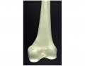 Posterior View Of Right Distal Femur