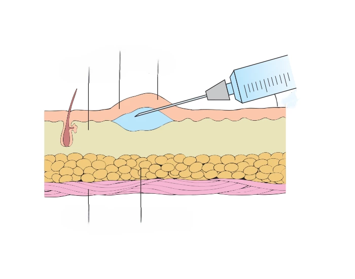INTRADERMAL INJECTIONS Quiz