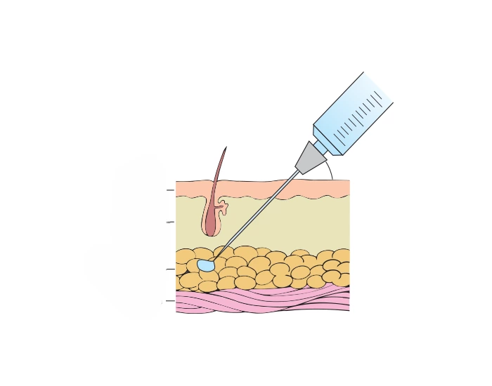 SUBCUTANEOUS INJECTIONS Quiz