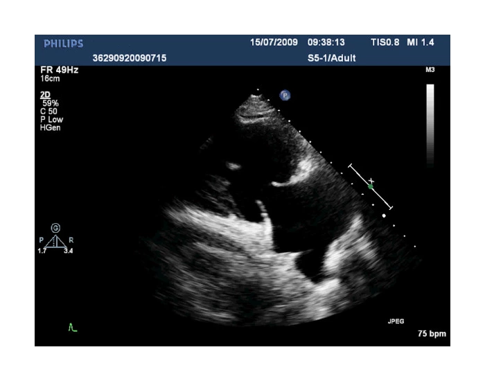 Plax Rvit With Color Right Ventricular Inflow View RVIT — Printable Worksheet