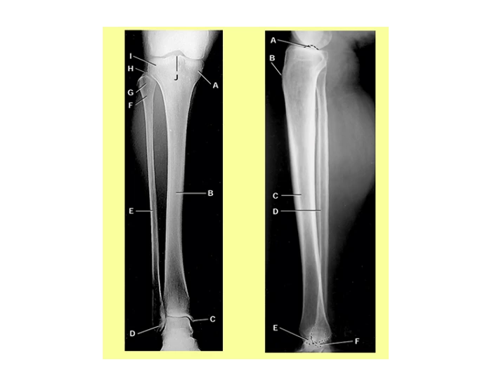 Tibia Fibula Radiograph Tibia and Fibula Radiograph Quiz