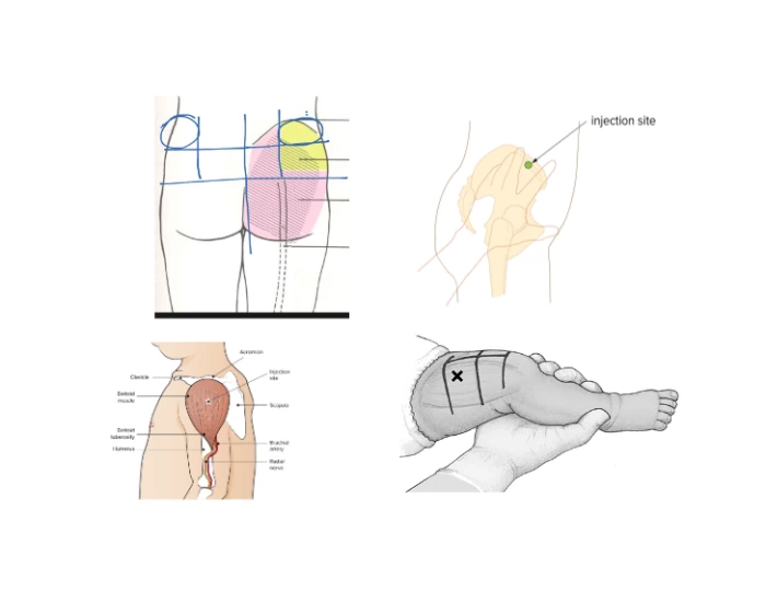 IM Injection Sites Quiz