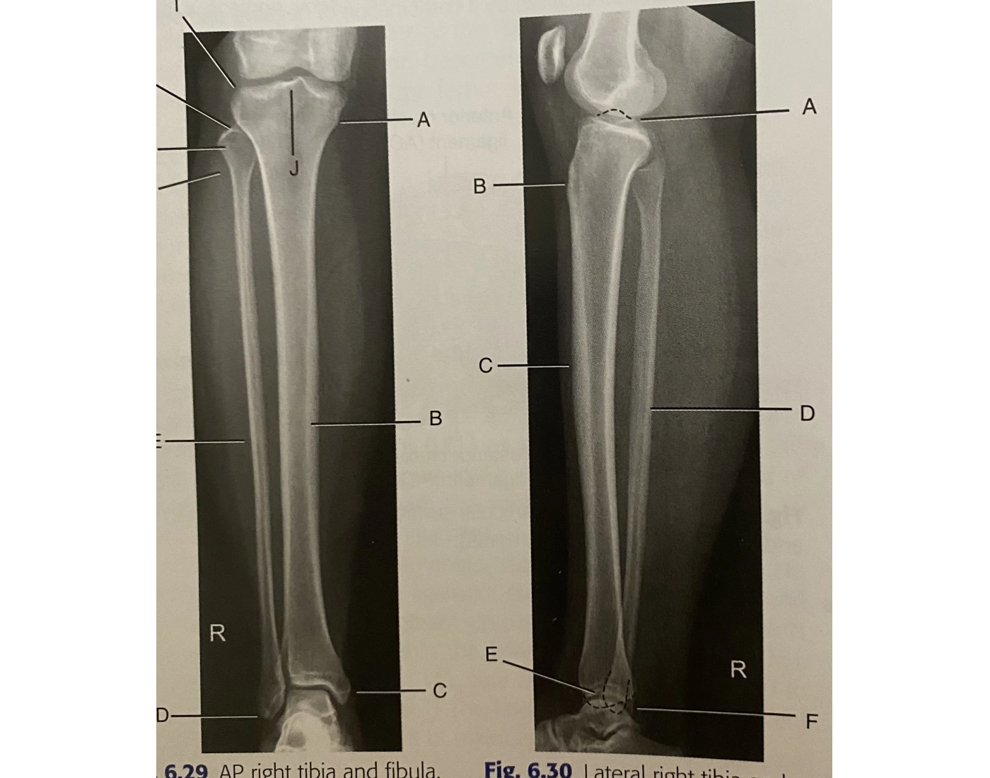 AP and lateral of tib-fib Quiz