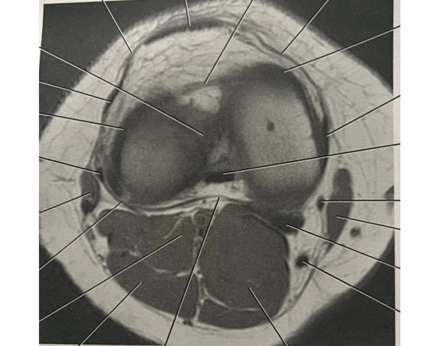 Pfd Rt Knee Axial T1 MRI of rt knee w/posterior cruciate ligam — Printable Worksheet