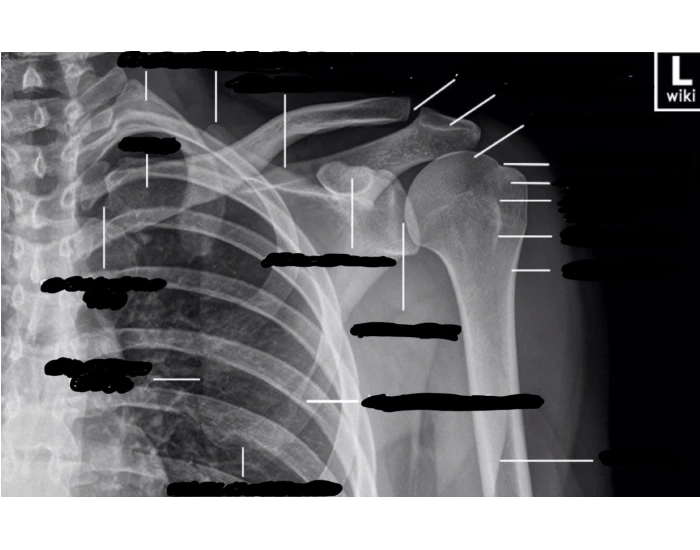 Rom Arc AP Shoulder External Rotation Quiz