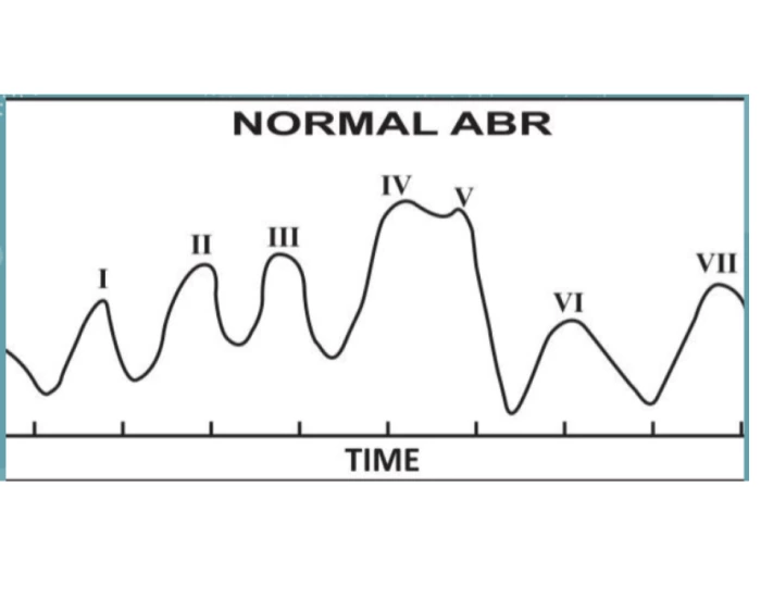 Normal ABR waves — Printable Worksheet