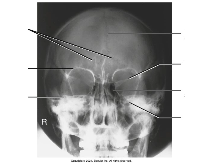 CaldWell Method Skull Anatomy Quiz