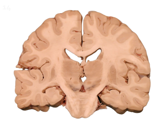 Label the Coronal Brain Cut — Printable Worksheet