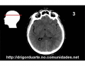 Tomografia axial cérebro 3