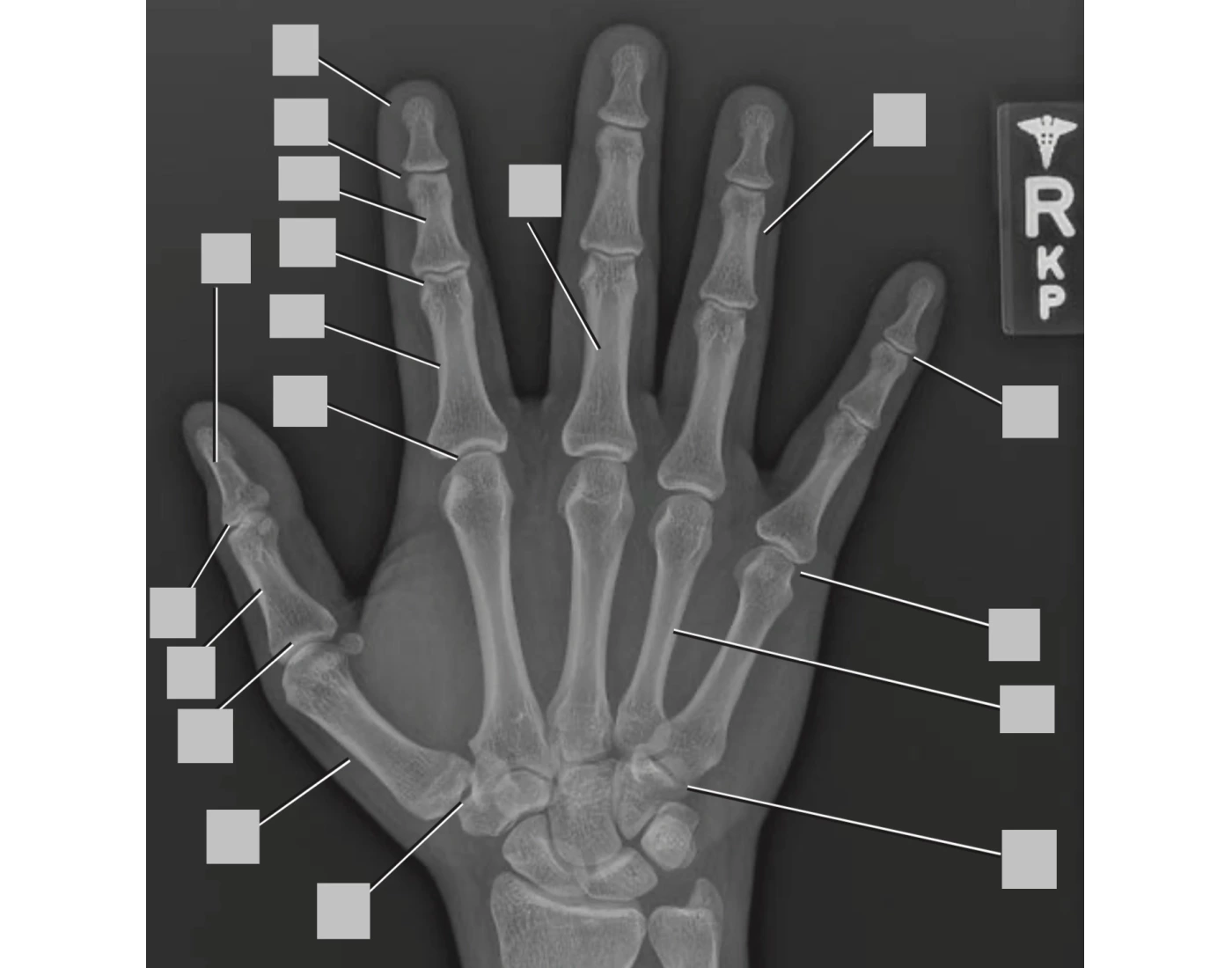 True Ap Hand PA hand radiograph Quiz