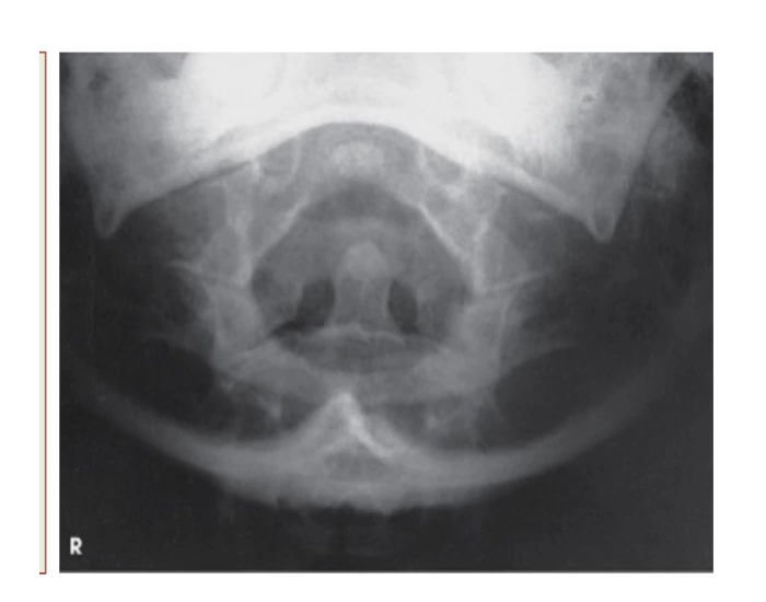 atlas and axis fuchs method Quiz