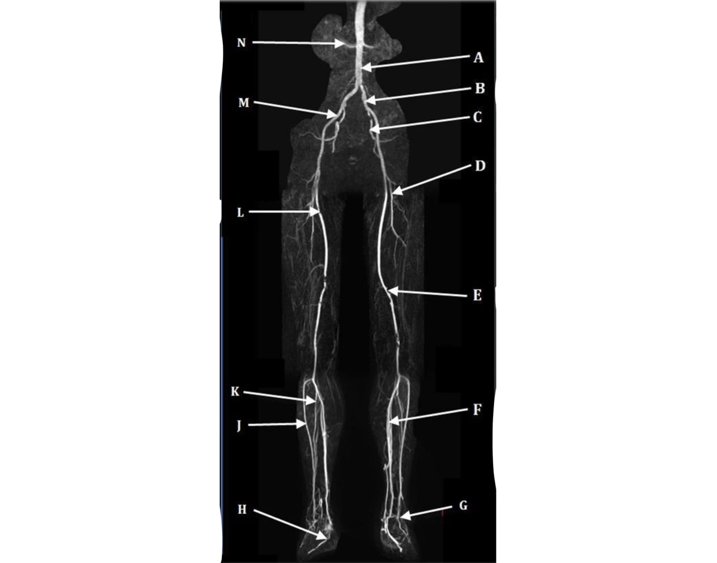 MRA runoff lower extremity Quiz