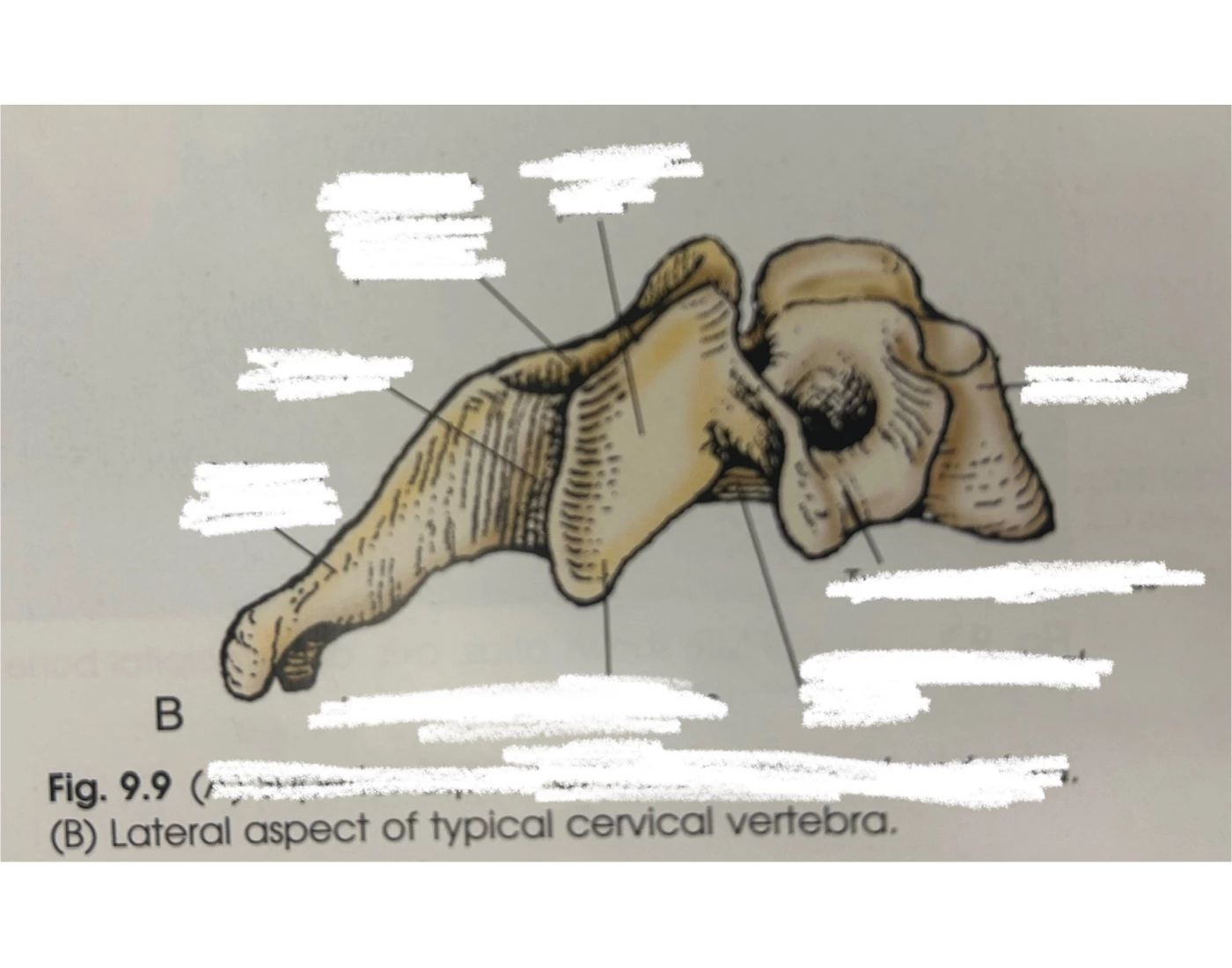 Lateral Aspect of Typical Cervical Vertebrae — Printable Worksheet