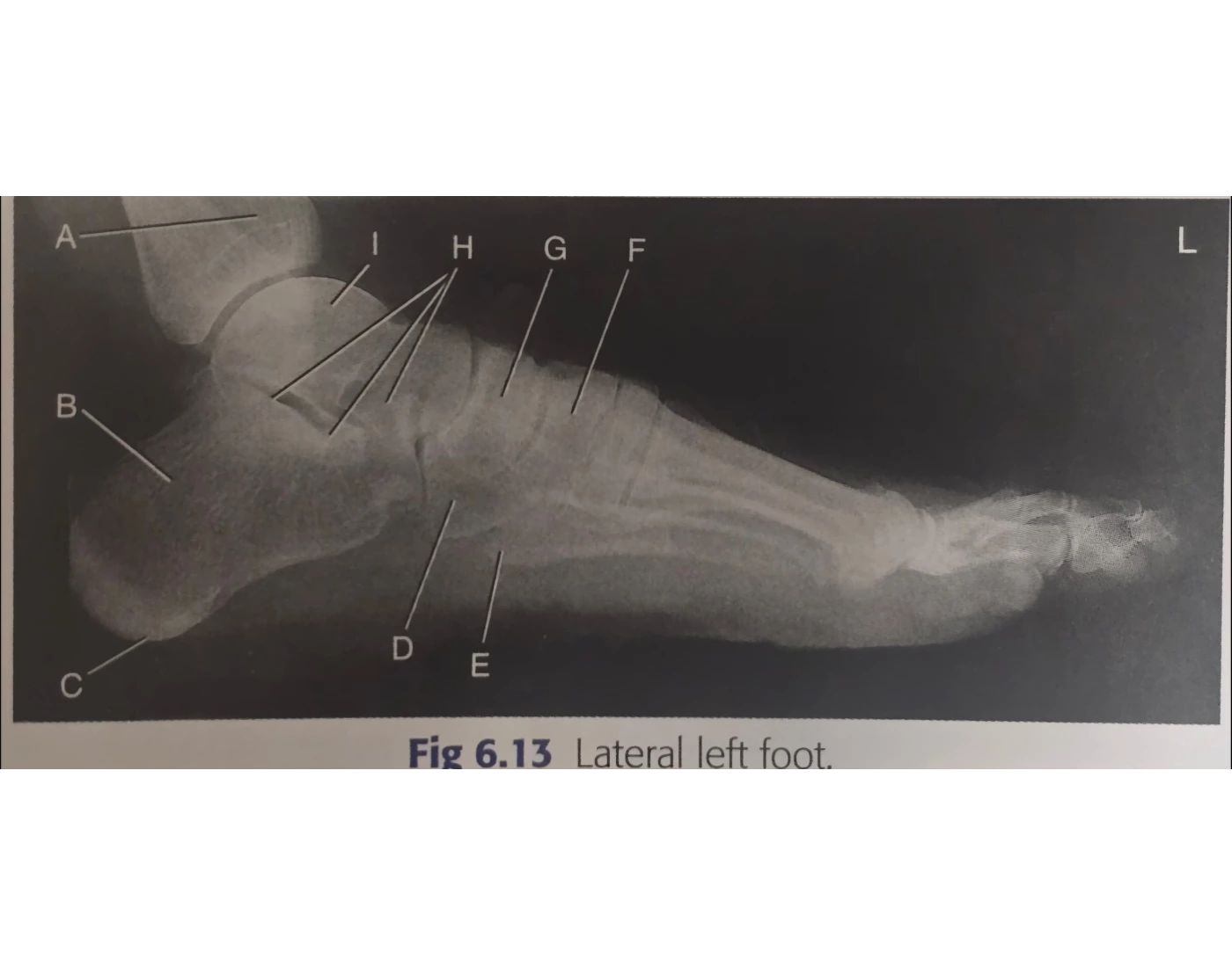 Radiographic Anatomy of Lateral Left Foot Quiz