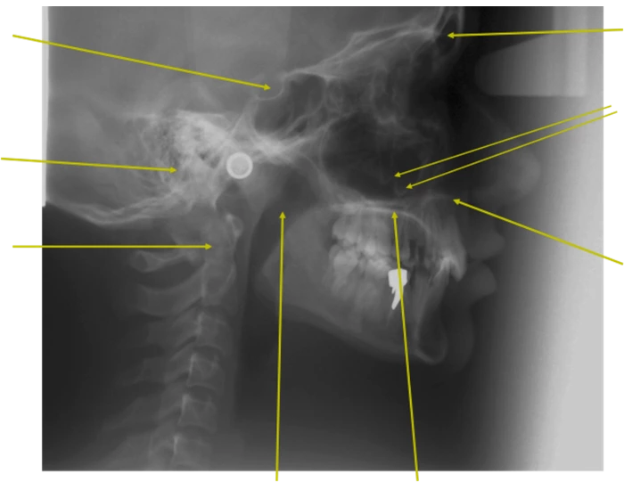 Normal Ceph Lateral Ceph Normal Anatomy Quiz