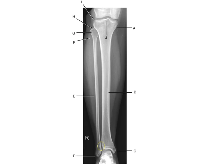 Anatomy Labeling: Tib/Fib Quiz