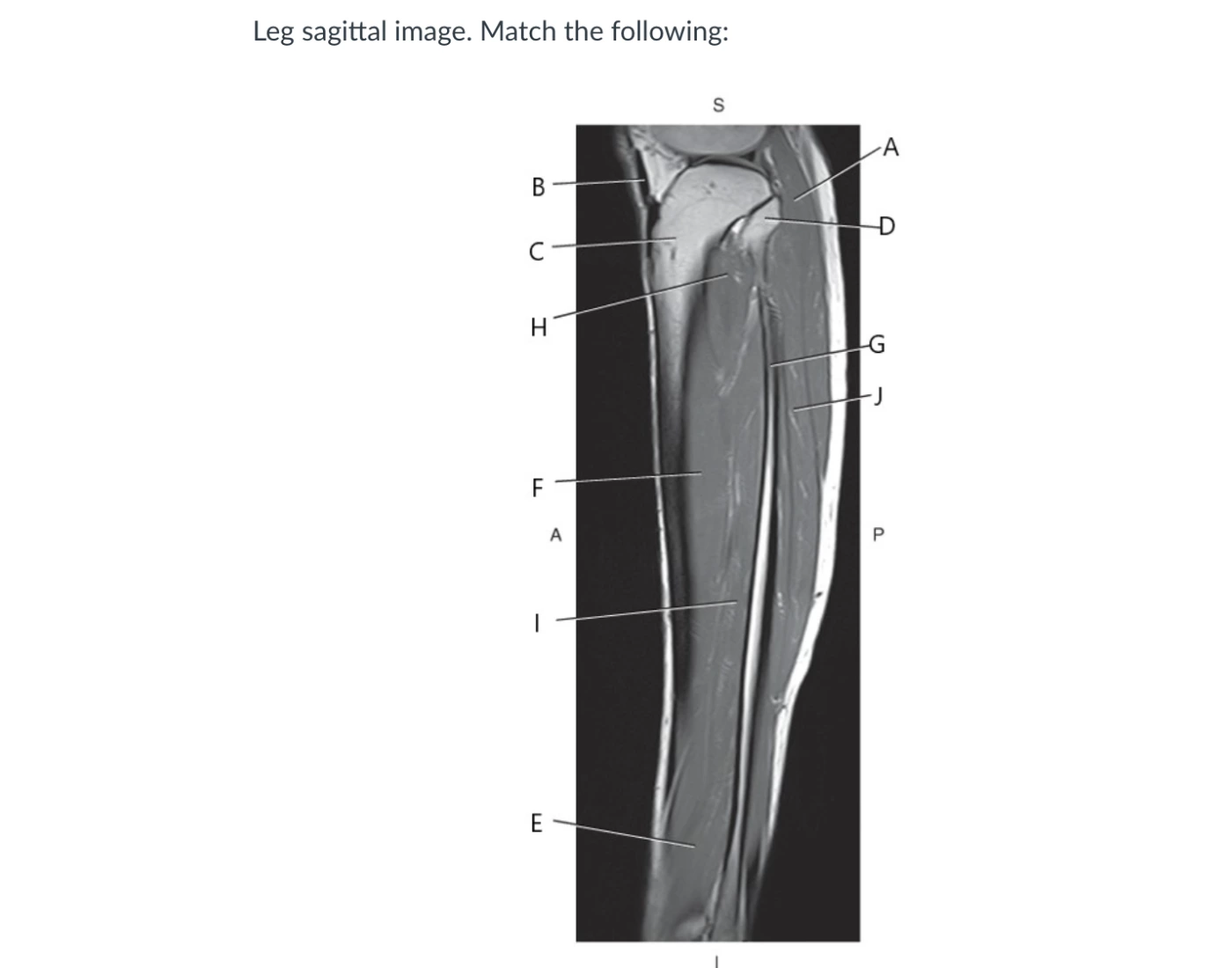 sagittal MRI of fibula Quiz