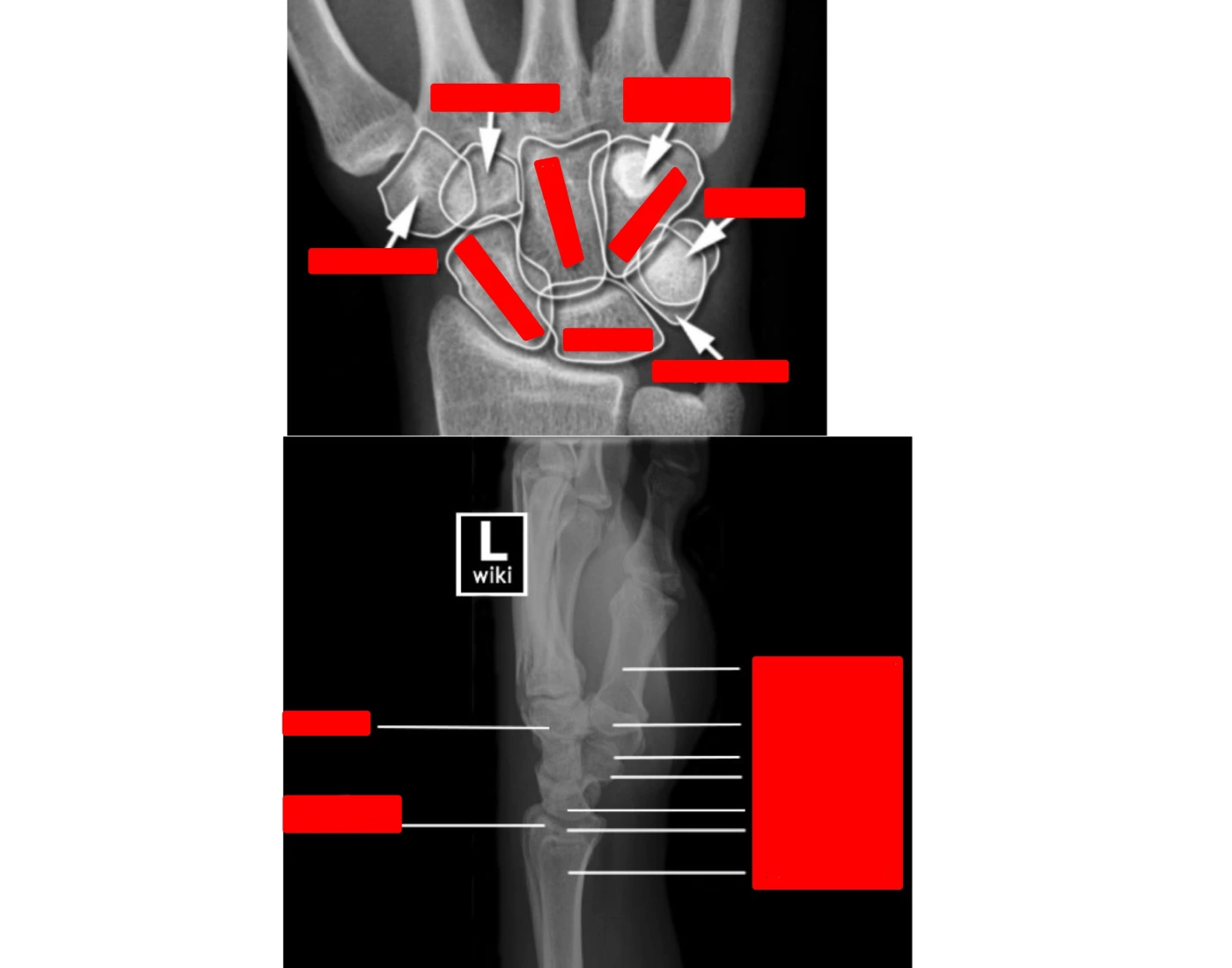 PA & Lateral Wrist Quiz