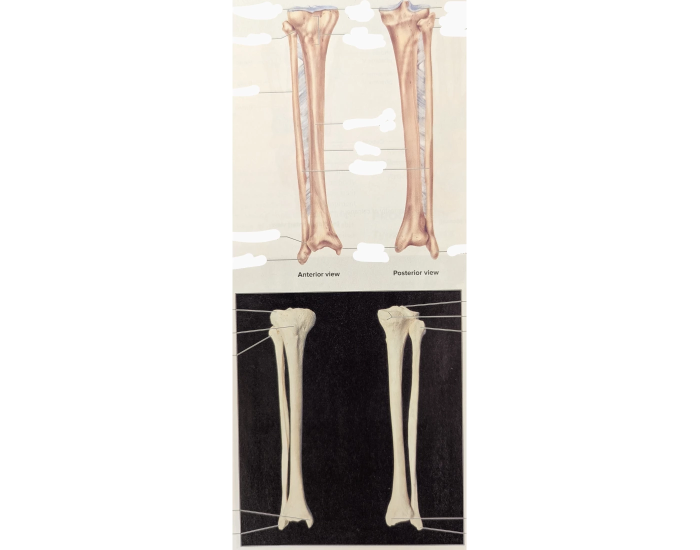 Right Tibia and Fibula Quiz — Printable Worksheet